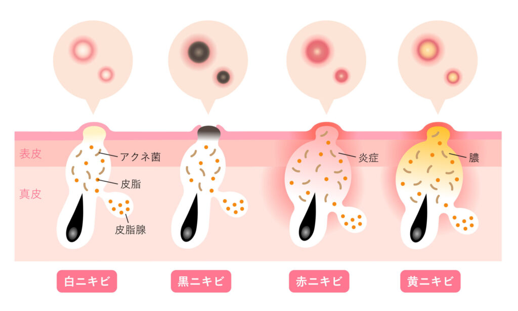 【画像】白ニキビ、赤ニキビ、黄ニキビ