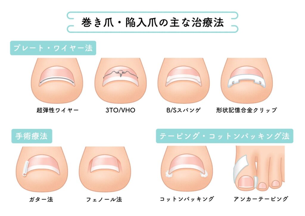 【画像】巻き爪_陥入爪_治療法 