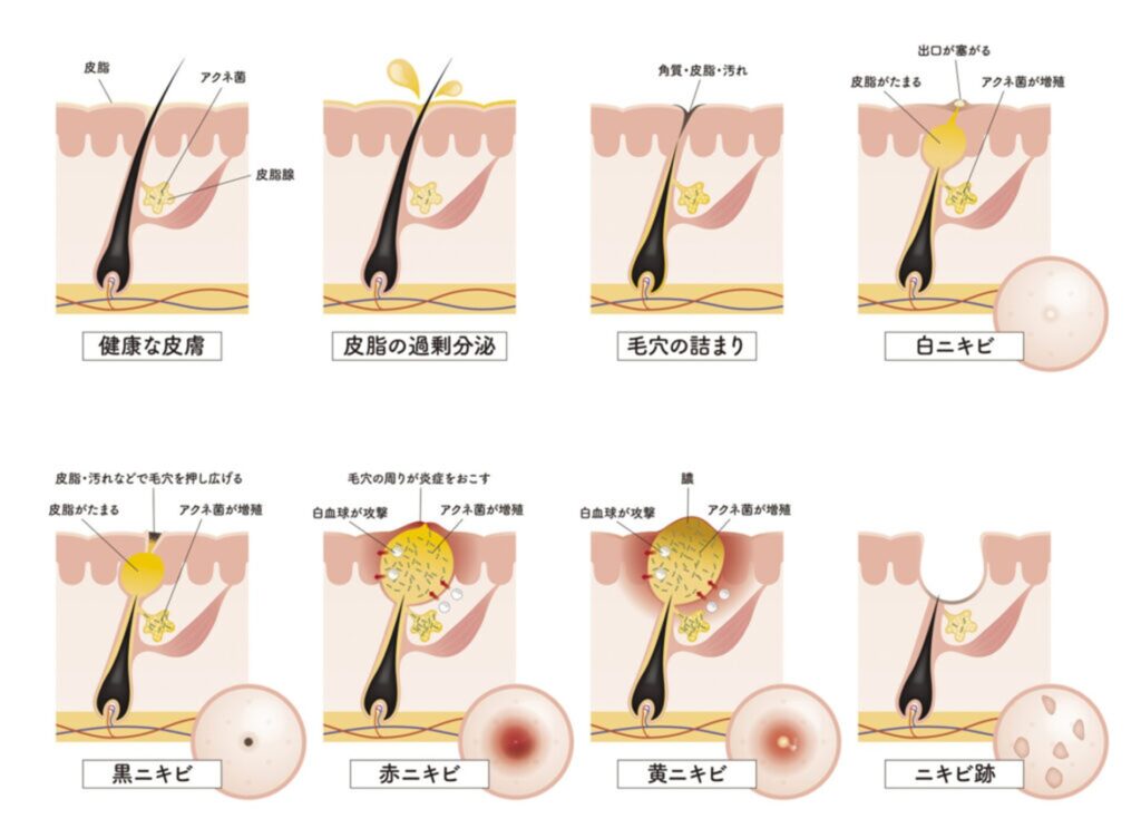 【画像】ニキビのタイプ