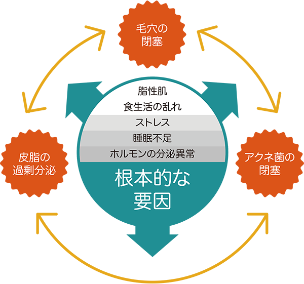 ニキビの複合的な原因