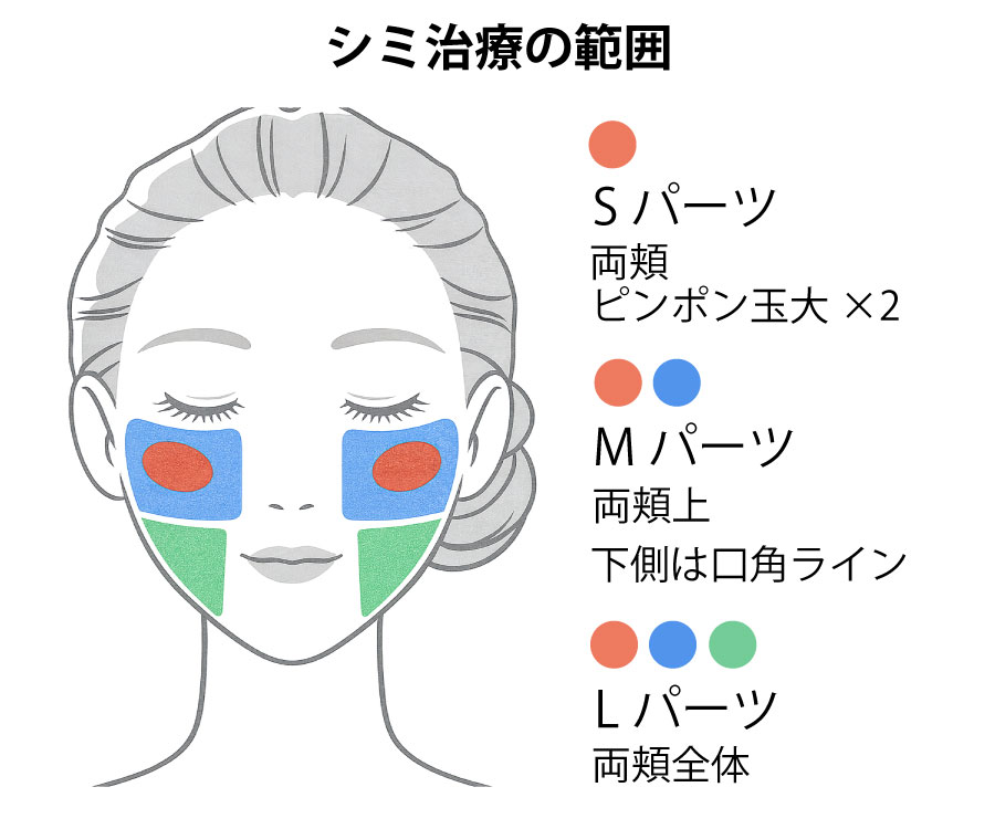 ADMまたは、シミ範囲照射の範囲