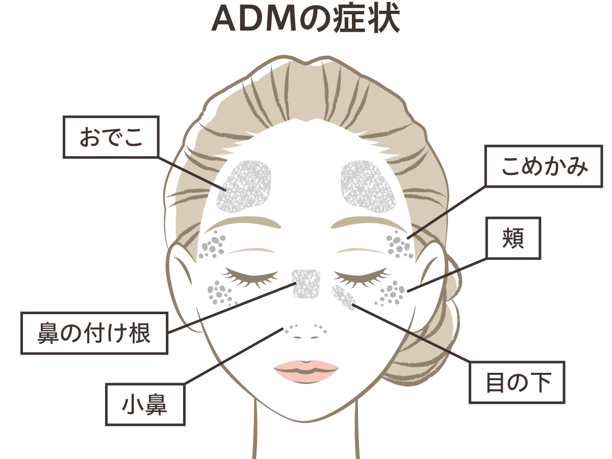 ADMの症状
