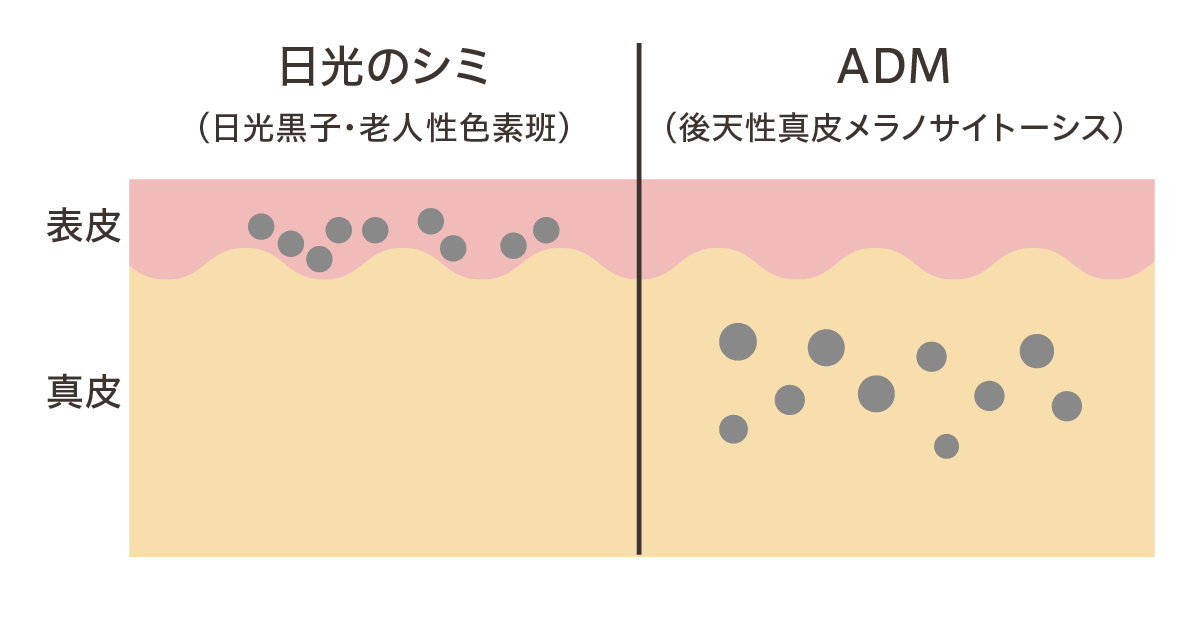 日光のシミ、ADMの画像