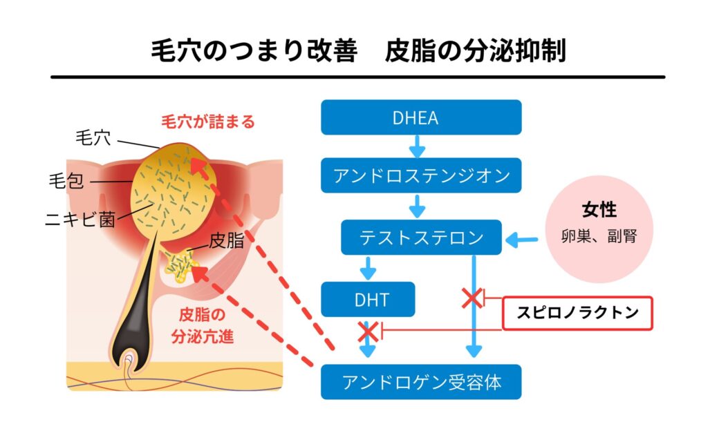 スピロノラクトンがニキビを改善させる理由