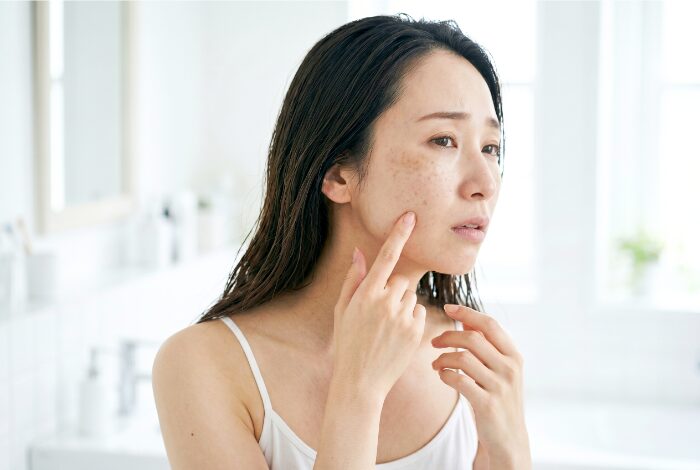 シミに悩む女性
