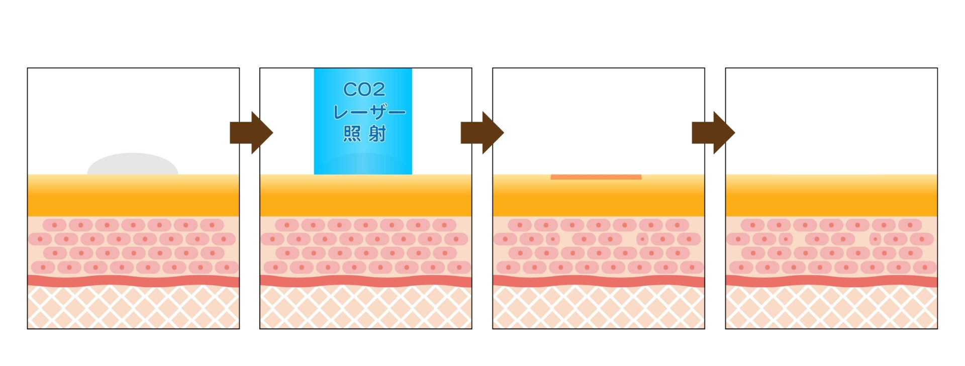 炭酸ガスレーザー（CO2レーザー）によるイボ治療のイメージ図