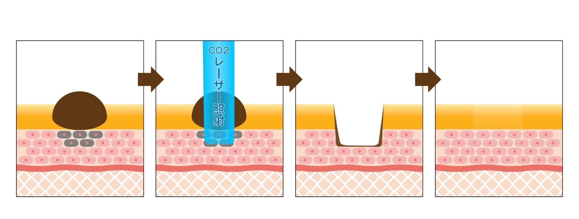 炭酸ガスレーザー（CO2レーザー）によるほくろ治療のイメージ図