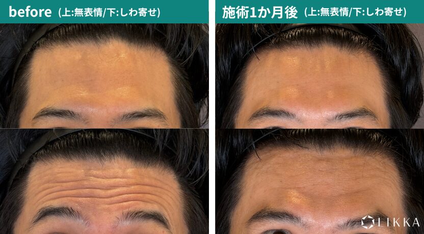 ボトックス注射 | 五反田の形成外科・皮膚科・美容皮膚科 | LIKKA